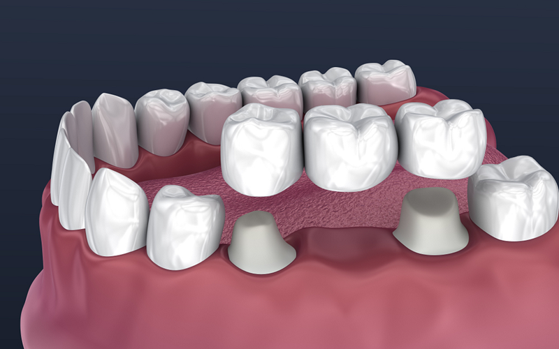 Dental Crowns And Bridges