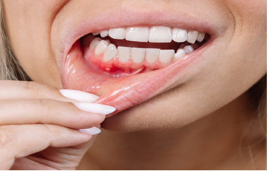 bleeding gums stop on their own